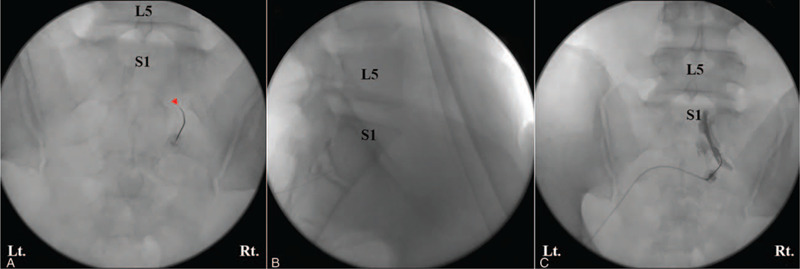 Scotty dog oblique view for S1 TFESI