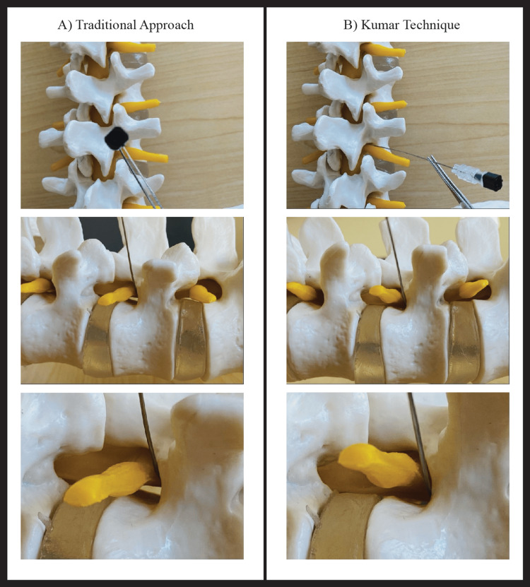 TFESI technique demonstration on anatomic spine model