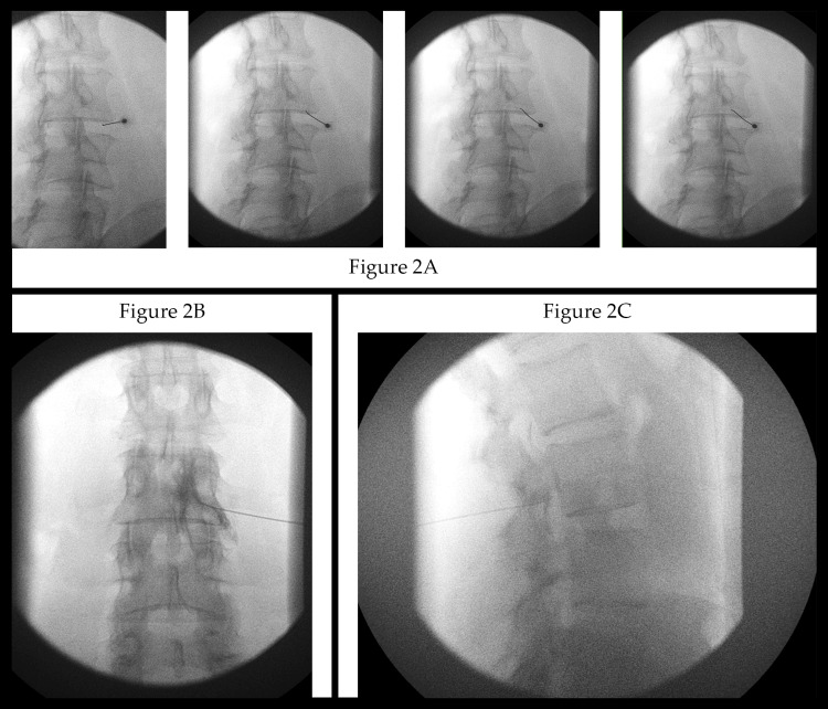 TFESI fluoroscopy: AP needle advancement and contrast spread